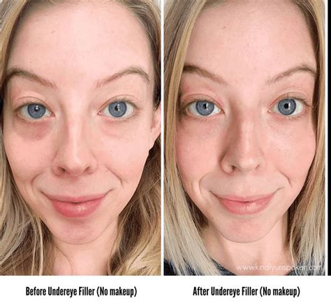 Under Eye Fillers For Dark Circles Before And After Kindly Unspoken