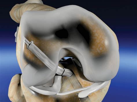 Rodilla Arthromeds