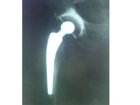 Cemented Total Hip Replacement Prosthesis X Ray After Operation