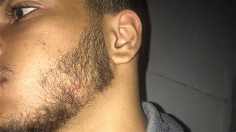 3 MESES USANDO MINOXIDIL RESULTADO MUITO RÁPIDO YouTube