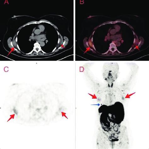 123 I MIBG And 68 Ga DOTATOC PET CT Of A 17 Month Old Patient With