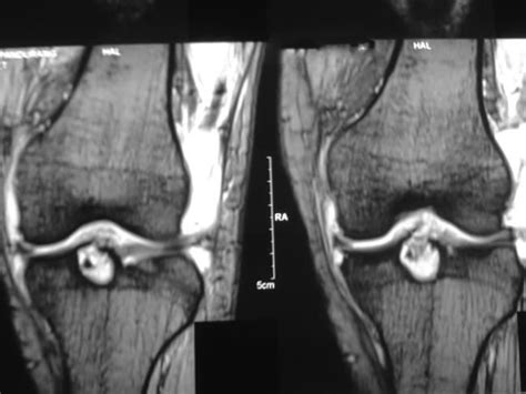 Mri Of The Knee Joint T Image A And B Showing Intraosseous Cyst