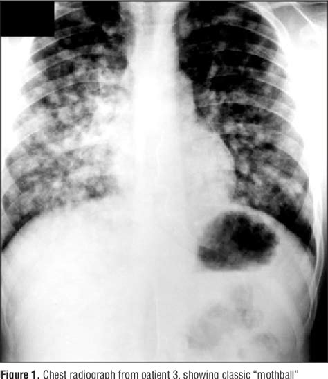 Figure 1 from High-altitude pulmonary edema in children with underlying ...