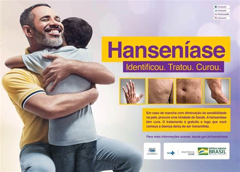 Hanseníase e o diagnóstico precoce Diersmann