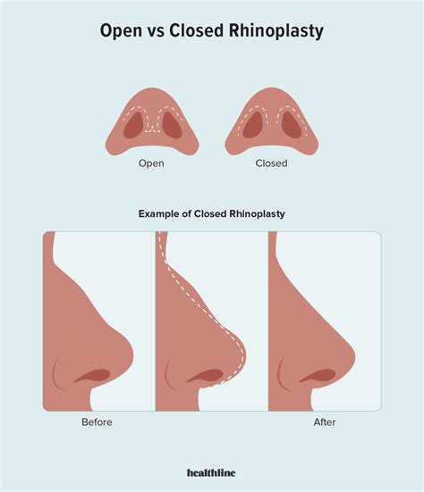 Closed Rhinoplasty Procedure Pictures Cost And Recovery