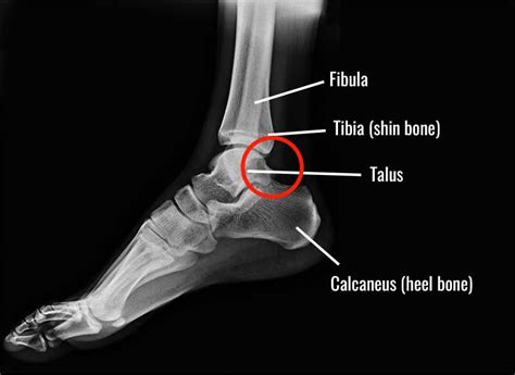 Posterior Ankle Impingement Symptoms Tests And Treatment