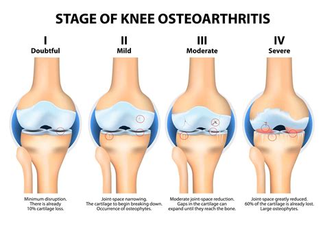 Bone on Bone | Knee Is Bone On Bone