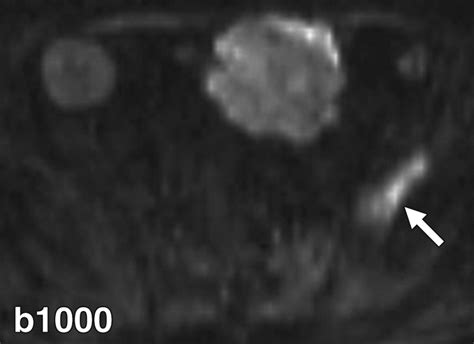 Characterization Of Genitourinary Lesions With Diffusion Weighted