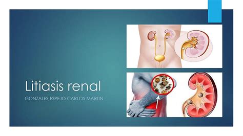 Litiasis Renal Etiologia Factores De Riesgo Diagnostico Y Tratamiento