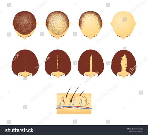 21 Set Of Four Stages Of Alopecia. Images, Stock Photos, 3D objects ...