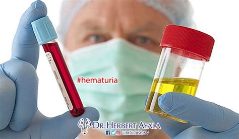 Hematuria Urologo El Salvador Dr Herbert Ayala