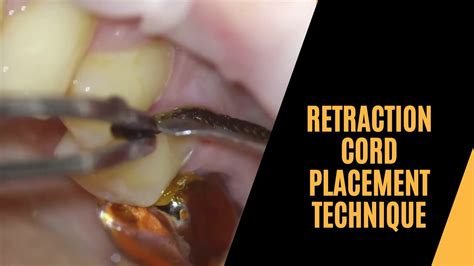 Retraction Cord Placement Technique Youtube