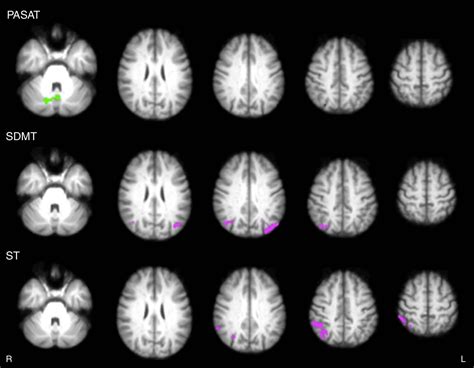 Video Games Improve Brain Connections In Multiple Sclerosis Patients