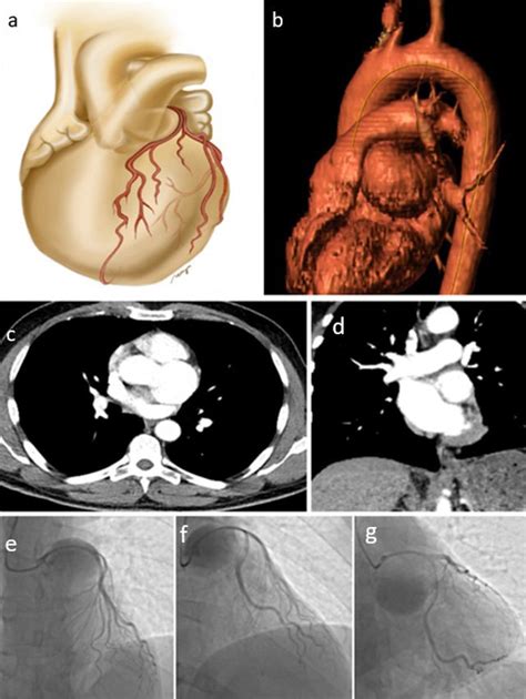 A And B Illustration Of Sinus Of Valsalva Aneurysm Sva Flattened