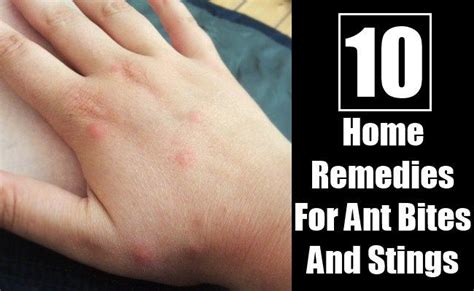 10 Amazing Home Remedies For Ant Bites And Stings Ant Bites Home