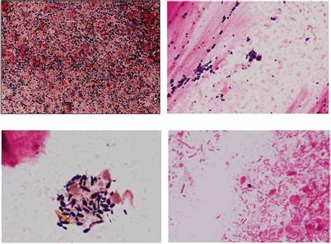 Fecal Gram Stain Shows That Simplified Bacteria Cover The Field Instead