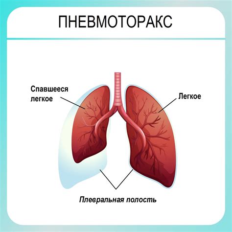 Пневмоторакс - причины, симптомы, диагностика и лечение