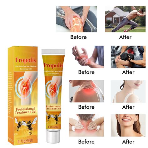 Vlemua Oz Zoencgz Bee And Venomcare Mole And Wart Treatment Cream