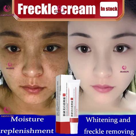 Yj Effective Whitening Freckle Cream Remove Melasma Acne Dark Spot