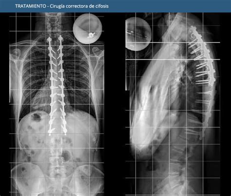 Cifosis Barcelona Spine Institute Bsi