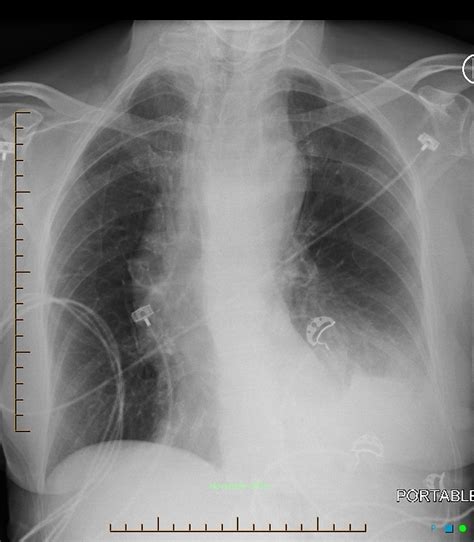 Aortic Dissection Radiology