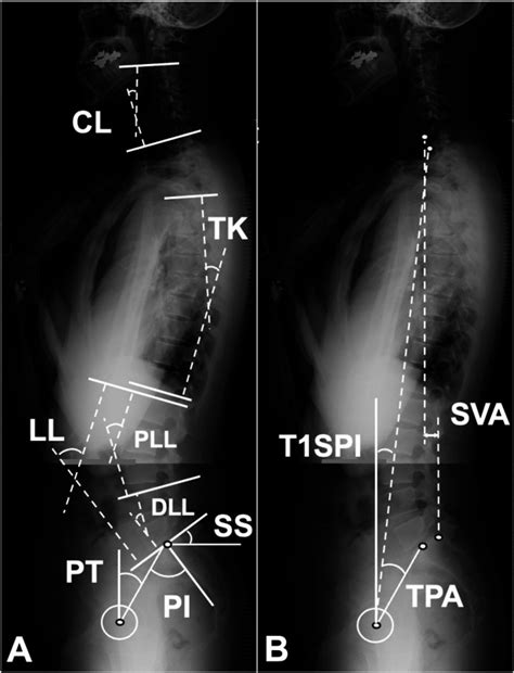 Sex Differences In Factors Affecting Spinopelvic Sagittal Alignment And