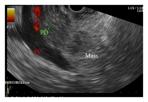 Linear Eus Showing An Inhomogeneous Hypoechoic Mass With Irregular Download Scientific Diagram