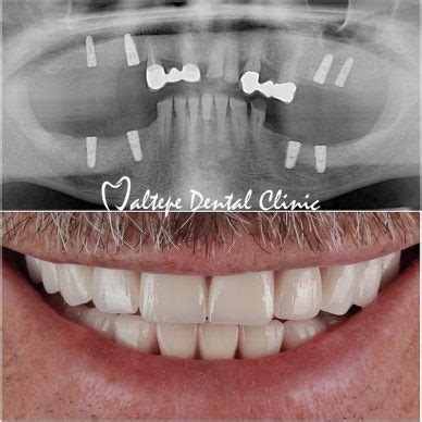 Full Guide To All On Four Dental Implants Maltepe Dental Clinic