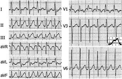 Supraventricular Tachycardia Due To An Accessory Pathway Avrt In An