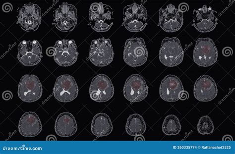 MRI BRAIN Finding of Meningioma Arising from Anterior Falx Cerebri ...