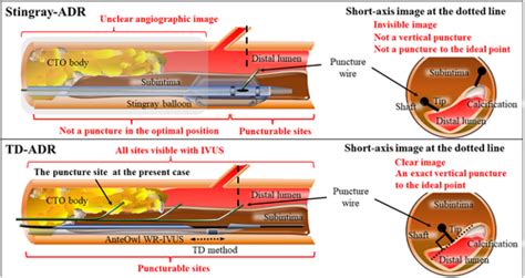 Jacc Cardiovascular Interventions Vol No