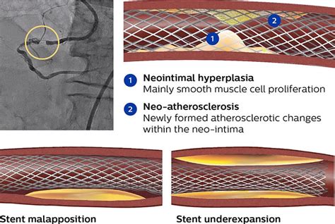 In Stent Restenosis Philips