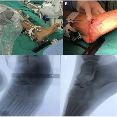 Intraoperative Operation Assisted By Tinavi Intelligent Orthopedic