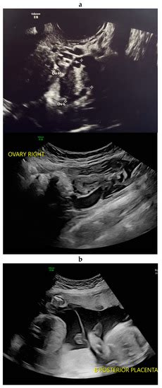 Reprod Med Free Full Text A Case Of Sex Discordant Dichorionic