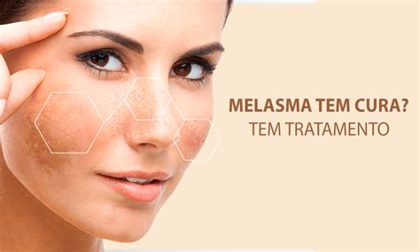 Melasma Tem Cura Tem Tratamento