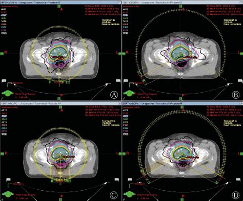 An Example Of The Dose Distributions Achieved With A One Full Arc