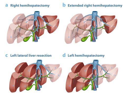 Liver Treatment Liver Surgery Perth Perth Liver Specialists And Surgeons