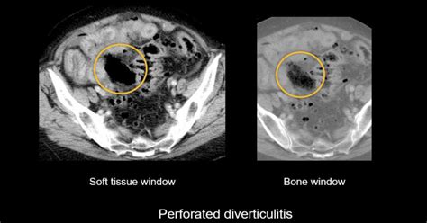 Abdominal CT: bowel perforation • LITFL • Radiology Library