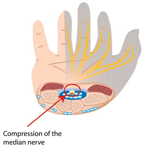 Carpal Tunnel Treatment Texas Health Care S Bone And Joint Clinic In