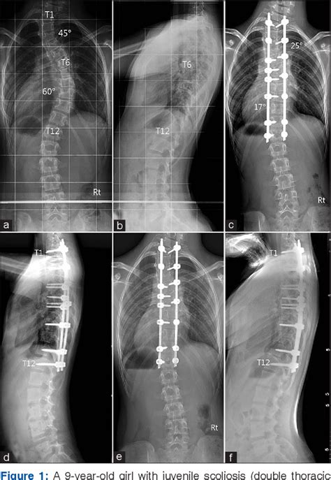 Figure From Accuracy And Safety Of Free Hand Pedicle Screw Fixation