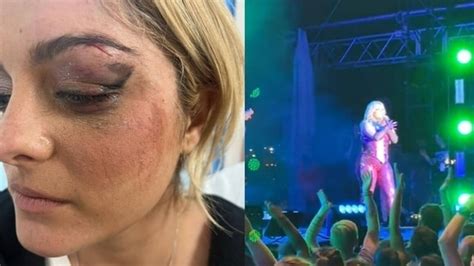 Bebe Rexha Shares Pics Of Deep Cut Sustained After Fan Hurled Phone At