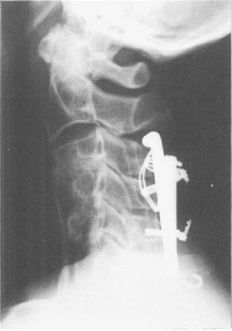 Figure 2 From Esophagocutaneous Fistula After Anterior Cervical Spine