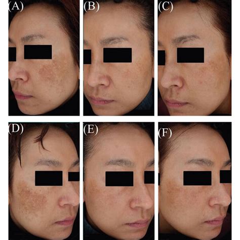 A Year Old Female Patient With Melasma Of Fitzpatrick Skin Type Iii