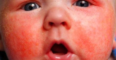 Psoriasis In Children: Treatment, Symptoms And Causes | Celebrities Funda