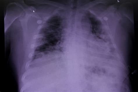 El daño pulmonar encontrado en fallecidos por COVID 19 puede arrojar