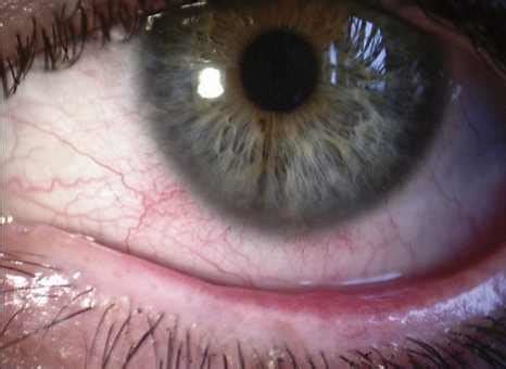 Ocular Rosacea - Pictures, Symptoms, Treatment and Causes