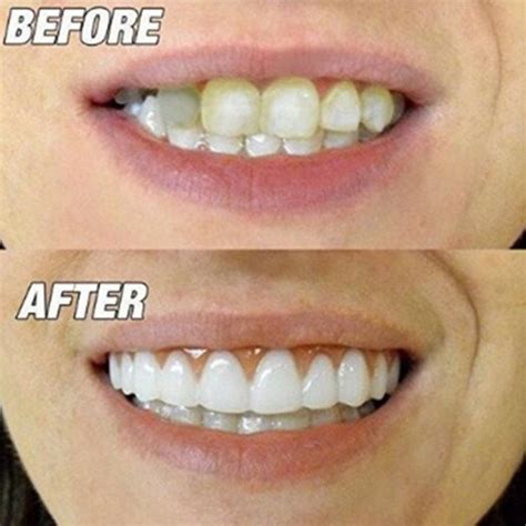 ᐉ Perfect Smile Veneers RECENSIONI vere • prezzo SCONTO -50% in ...