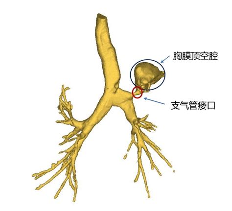 匠心修补“支气管胸膜瘘” 九院为危重患者解除带“管”痛苦