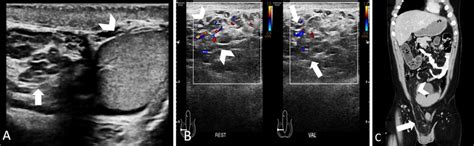 Mimicker Of Varicocele A Scrotal Ultrasound Shows Multiple Anechoic Download Scientific