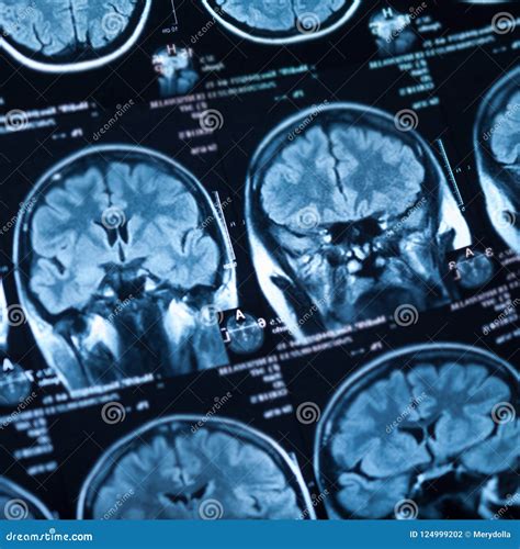 The X Ray Of The Human Brain Stock Photo Image Of Neurology Scan